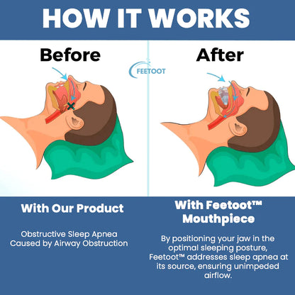 ANTI SNORE MOUTHPIECE